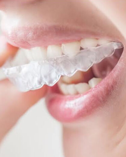 bite anti russamento e anti digrignamento2